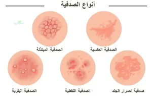 علاج الصدفية نهائياً